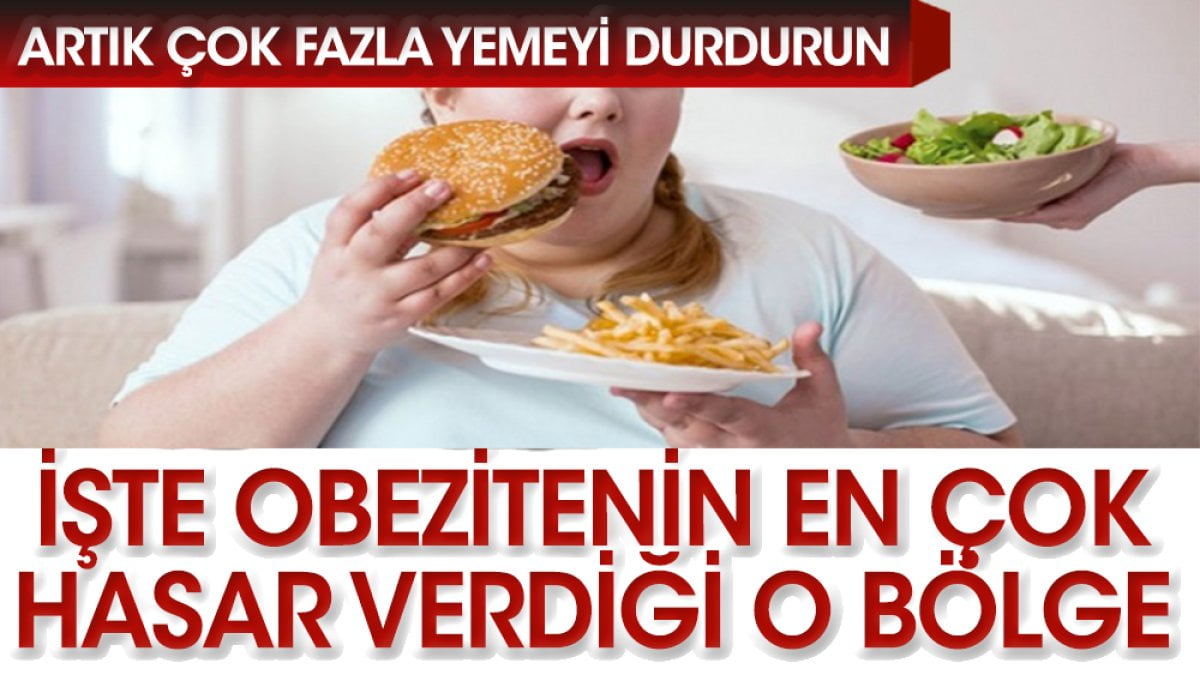  Obezite, vücuttaki yağ dokusunun normalden fazla olması durumunda ortaya