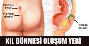 Kıl dönmesi, kılların kuyruk sokumu ve nadiren göbekte cilt altına