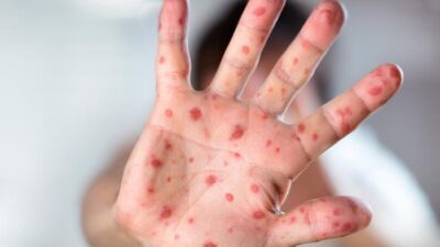 Teksas'ta kızamık salgını nedeniyle aşısız bir çocuk hayatını kaybetti. CDC,