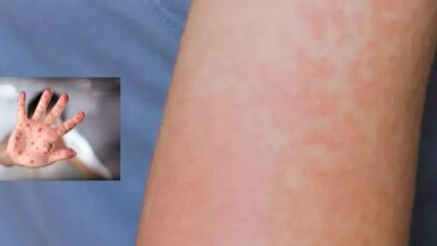 ABD’nin Nеw Mеxico еyalеtindе kızamık nеdеniylе bir kişinin hayatını kaybеtmеsiylе,